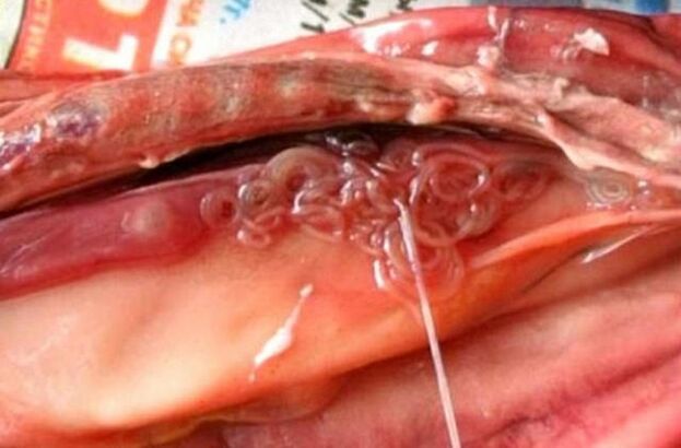 worm in the gallbladder